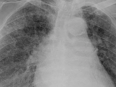 tuberculosis