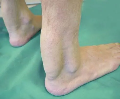 Xantomatosis Cerebrotendinosa