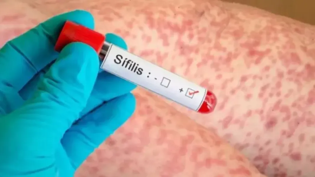 Sífilis