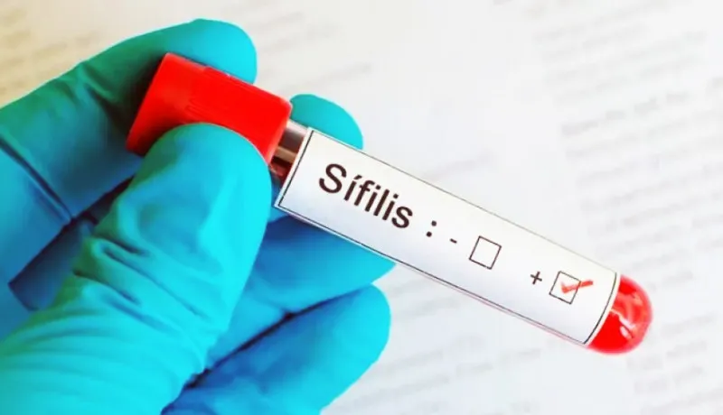 sifilis 
