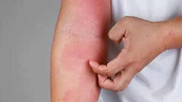 dermatitis atópica