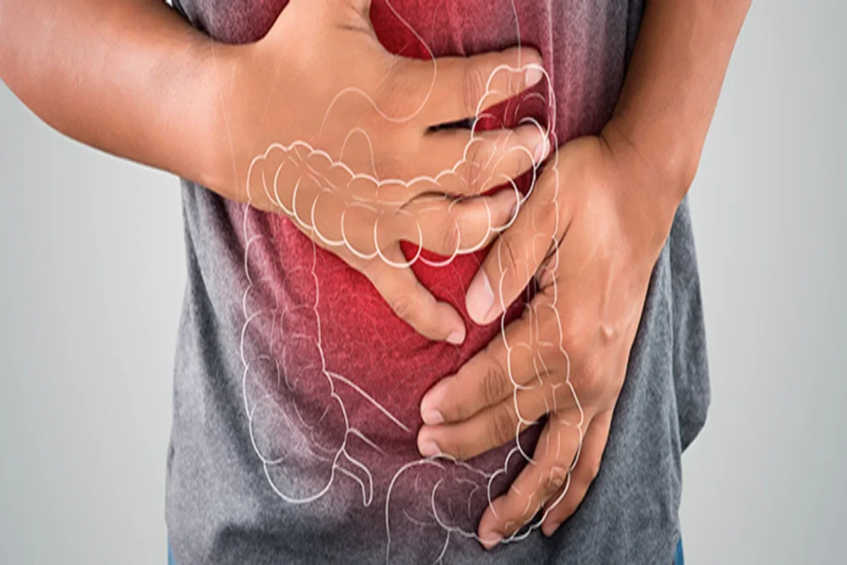 Enfermedades Inflamatorias Intestinales (1)