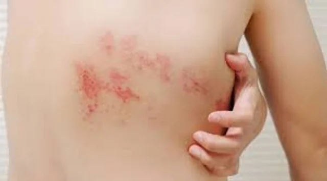 herpes zóster