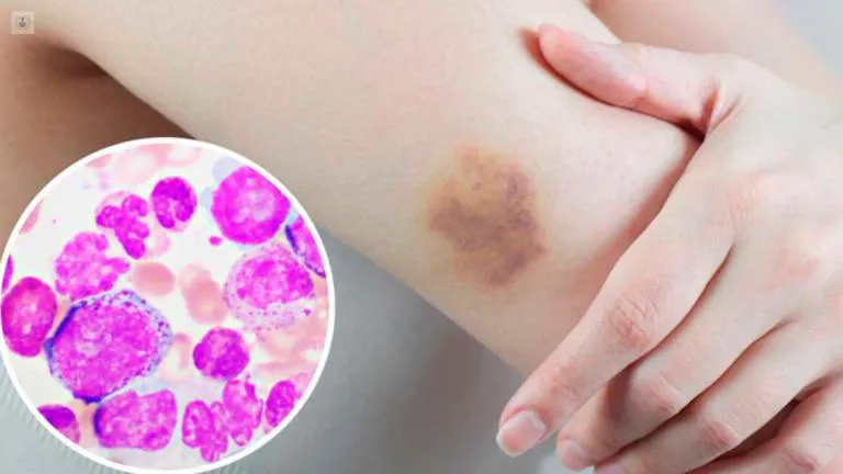 leucemia mieloide aguda