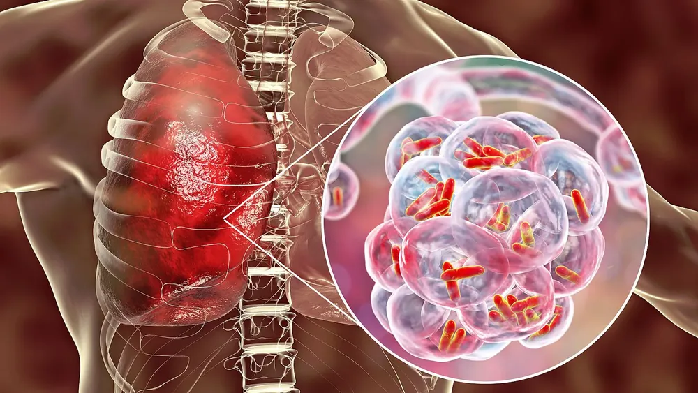 tuberculosis 