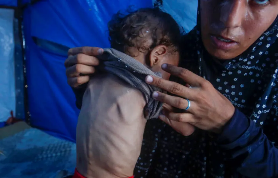 Desnutrición Gaza