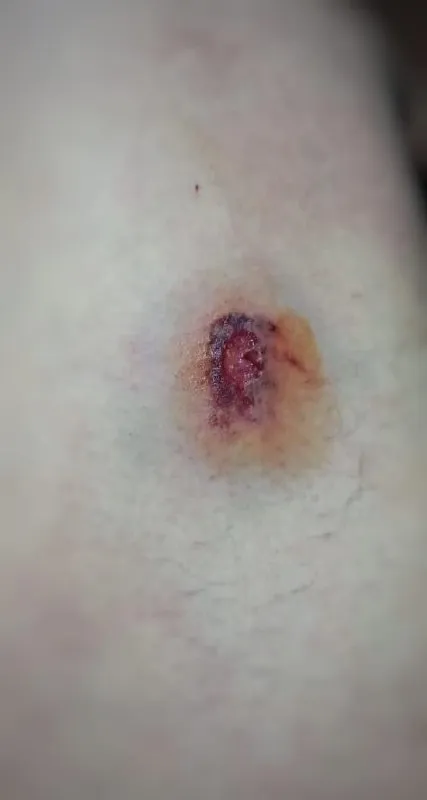 mordedura policia